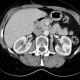 Metastasis in duodenal wall: CT - Computed tomography